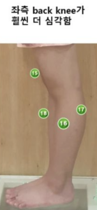 반장슬 종아리가 뒤로 밀림 빽리