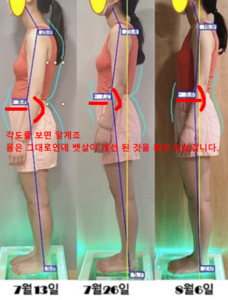 골반전방경사